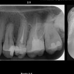 Revoluția Microscopului în Endodonție: De ce să alegi un tratament asistat de tehnologie?