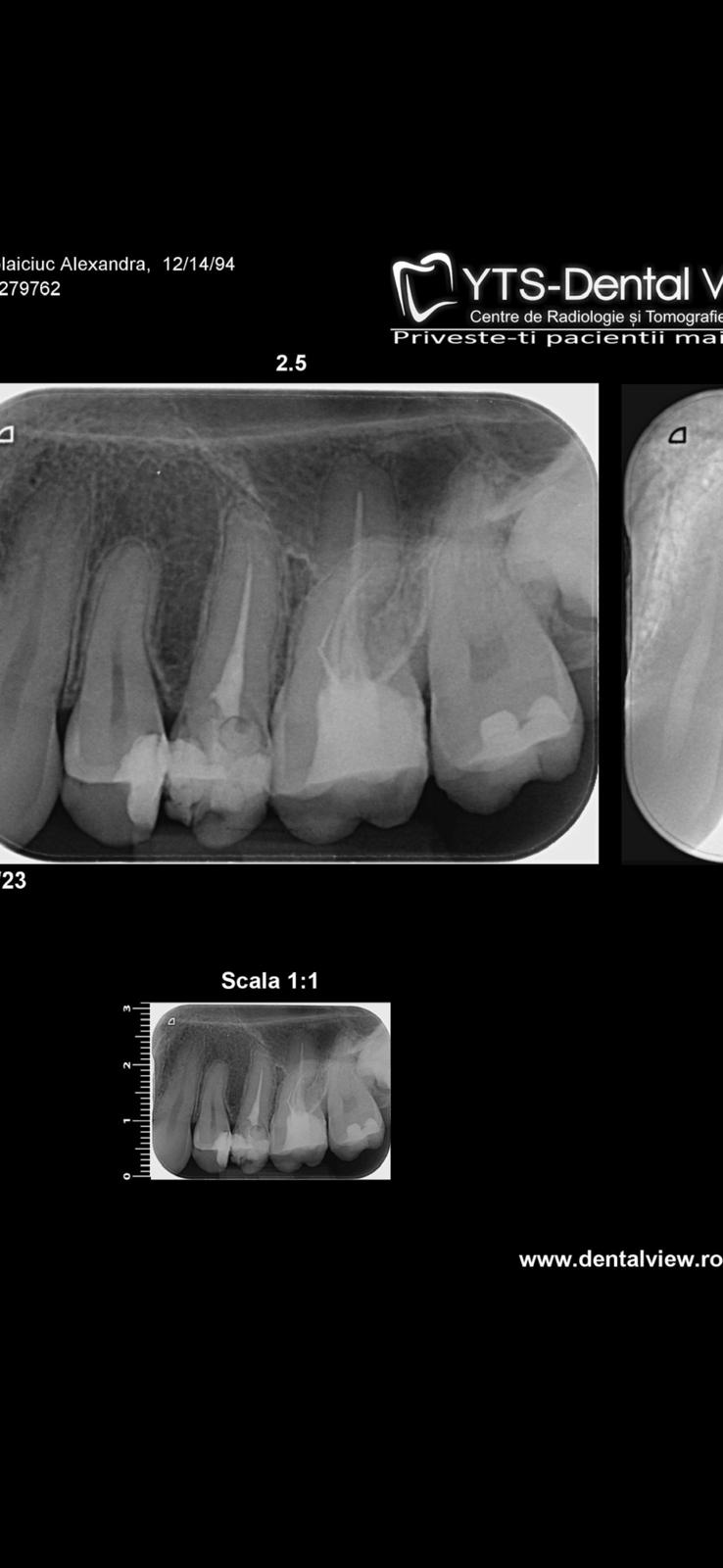 Retreatment — fragment fracturat