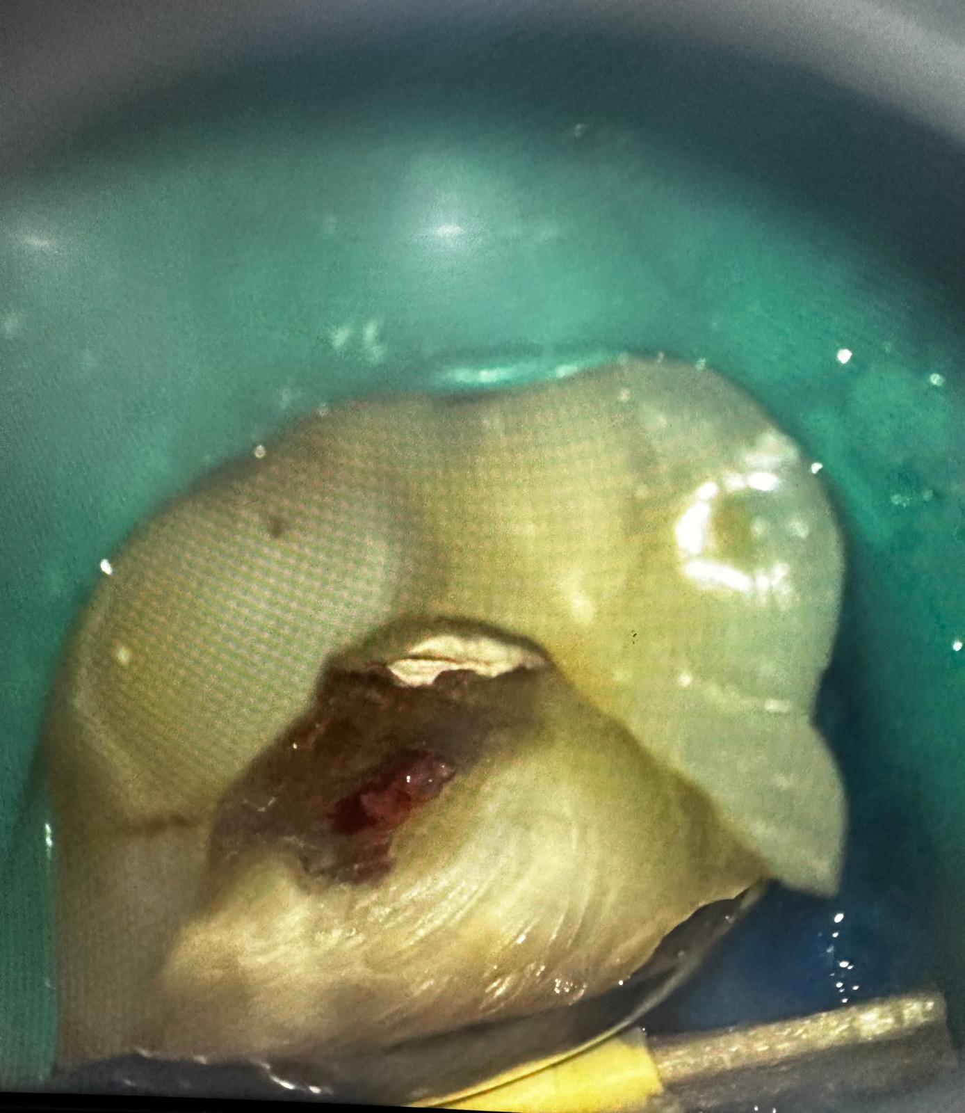 Exereză dentină alterată, gingivectomie și reconstrucție DME