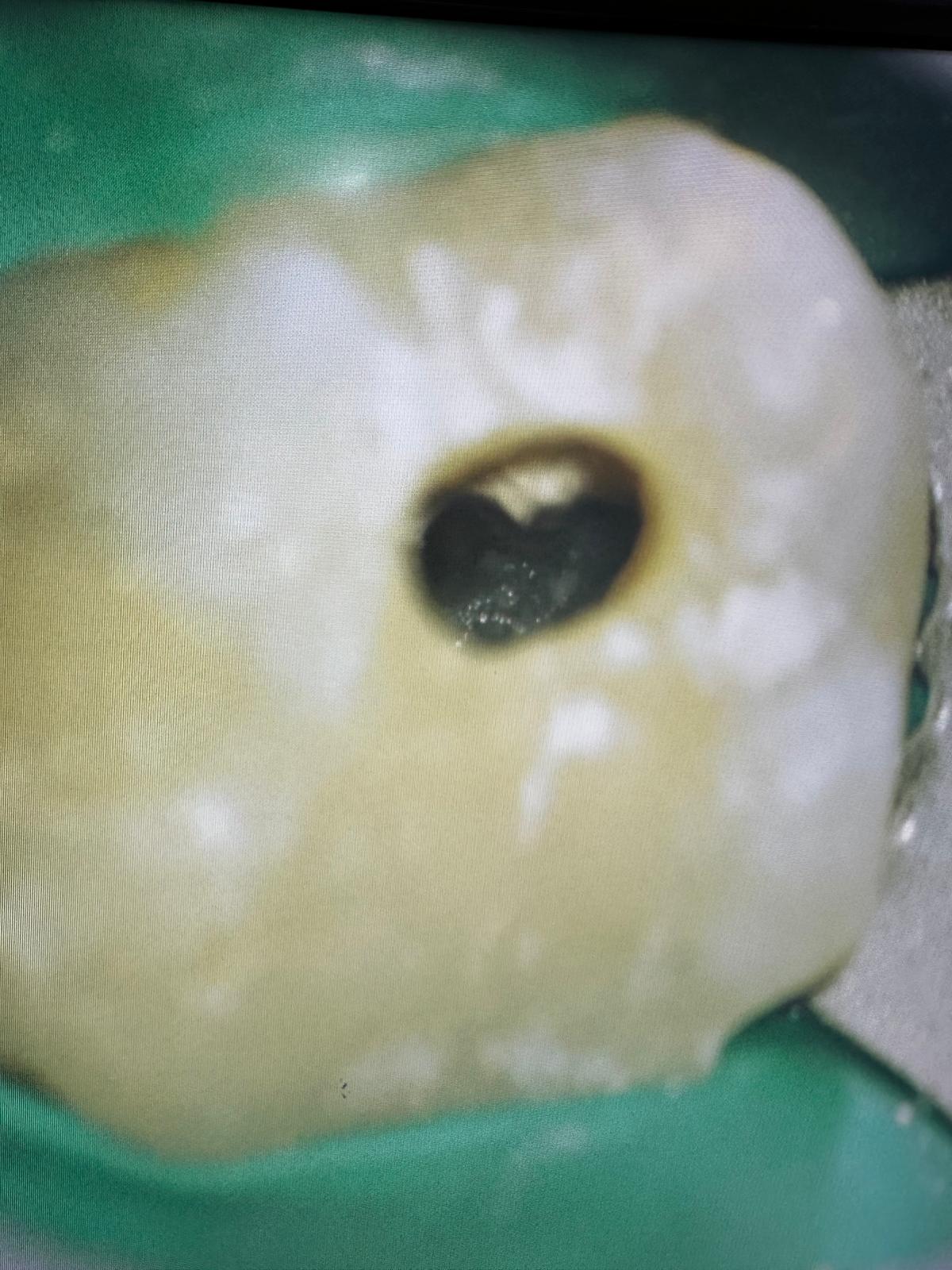Instrumentarea sistemului endodontic