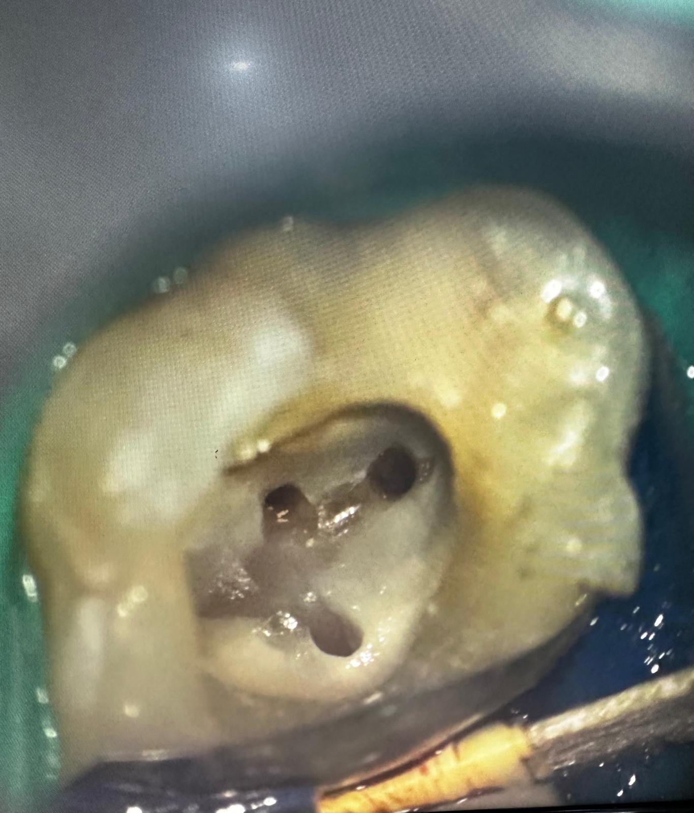 Pregătire intraoperatorie sistem endodontic pentru obturare