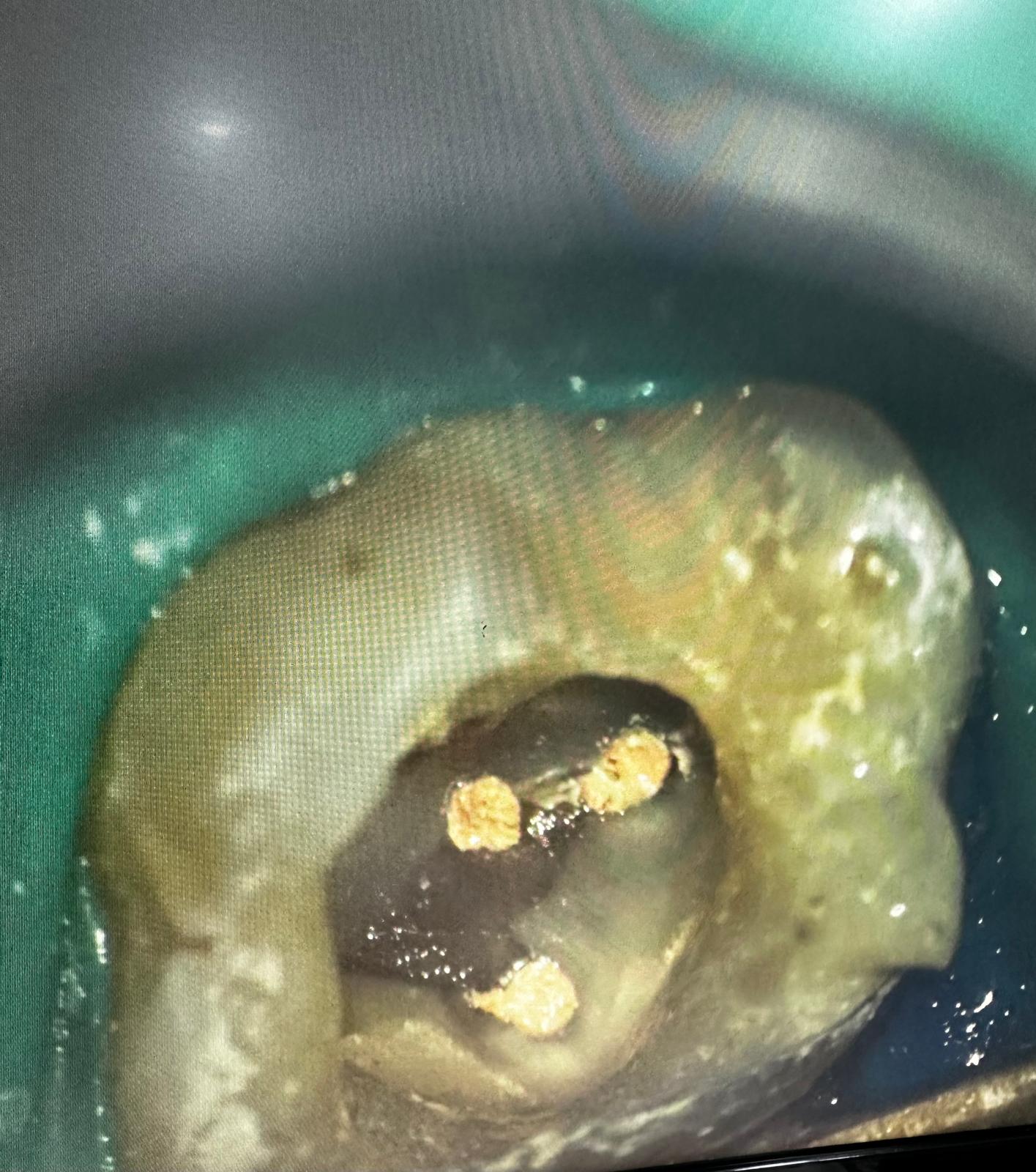 Obturarea sistemului endodontic