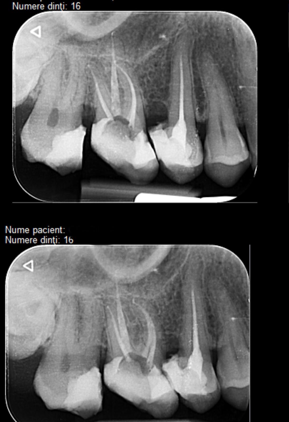 Radiografie preoperatorie molar 16