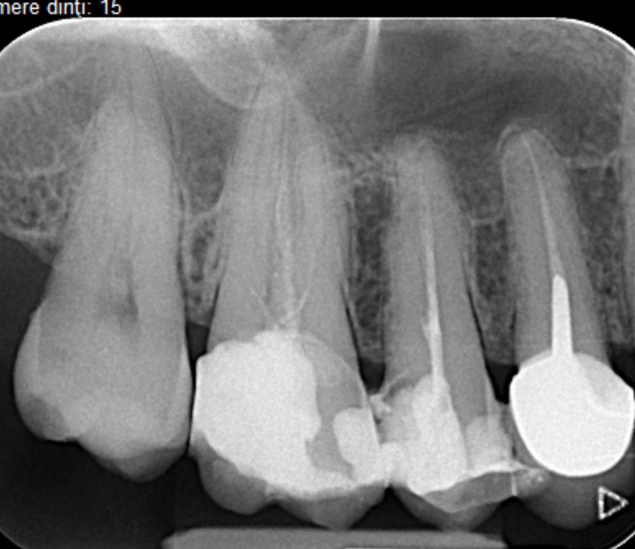 Radiografie preoperatorie molar superior