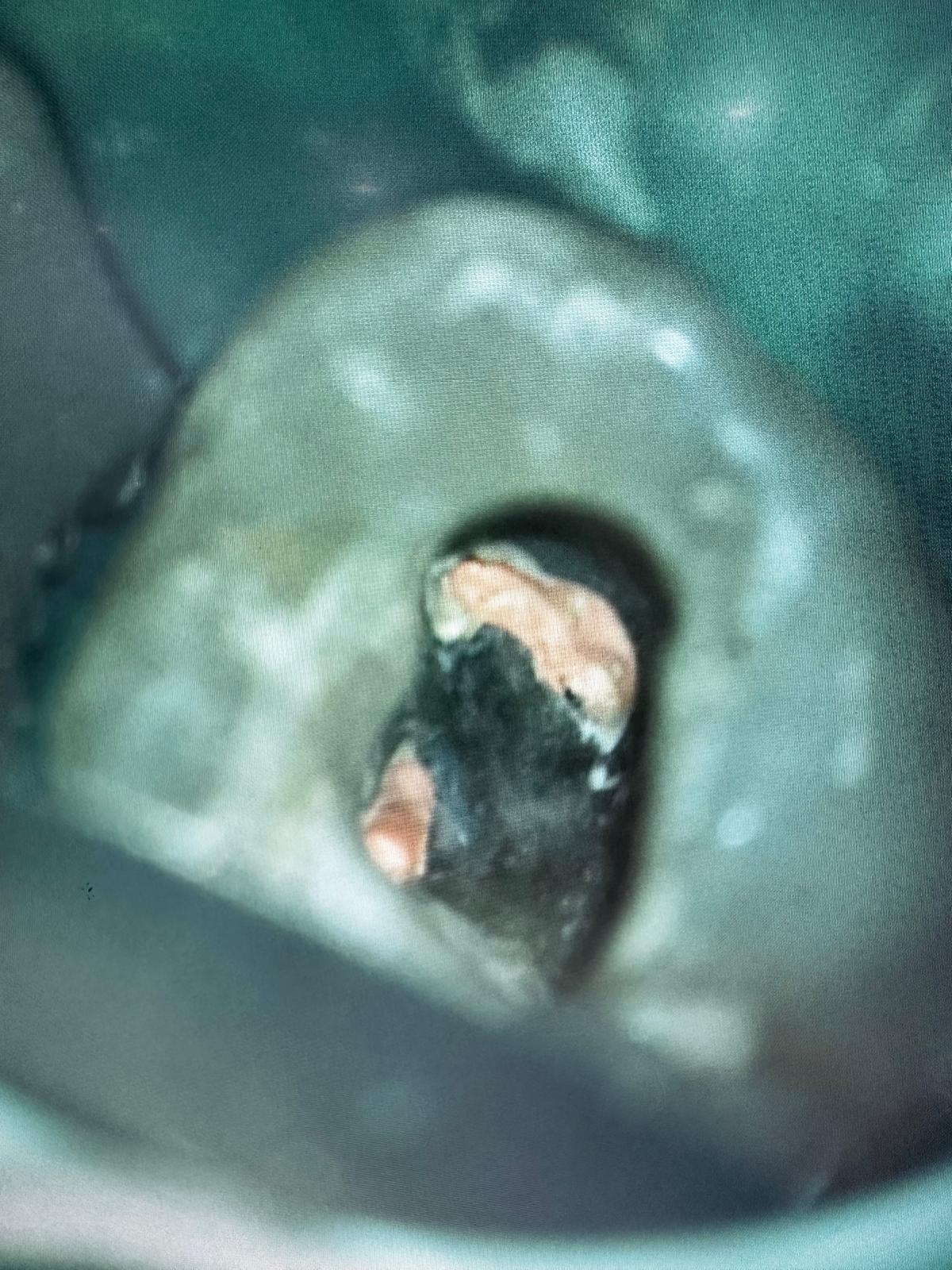 Sigilarea sistemului endodontic