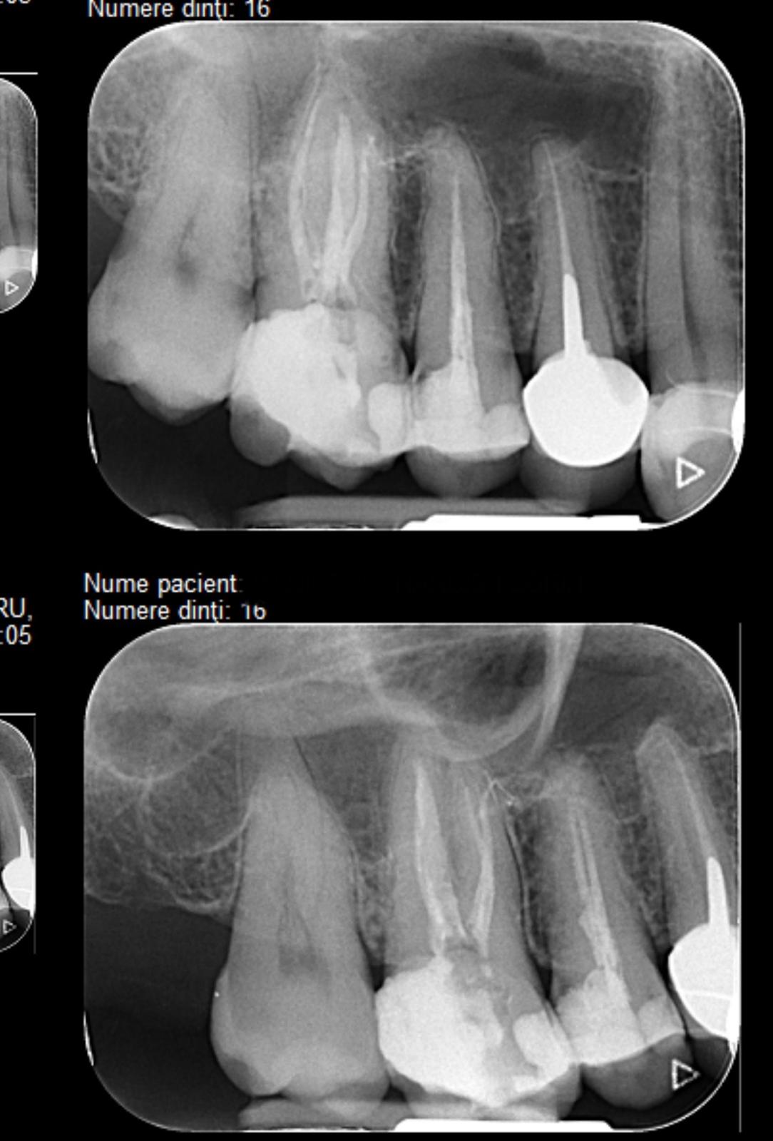 Radiografie postoperatorie molar superior