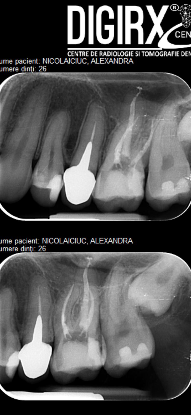 Radiografie postoperatorie de control